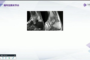 丁香园:骨关节 MRI 全面解读【共12节】【298元】 百度网盘(6.16G)