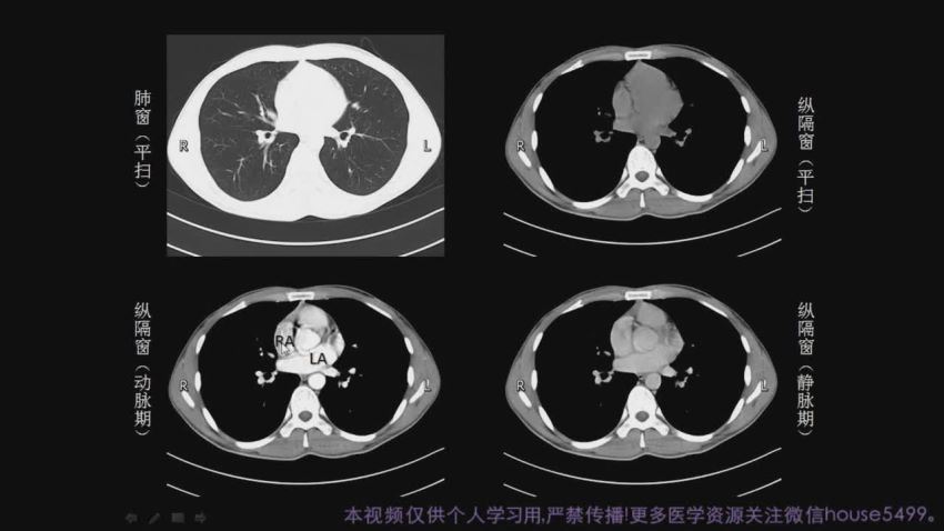 丁香园：付费课丨手把手教你读懂肺部 CT 百度网盘(12.95G)