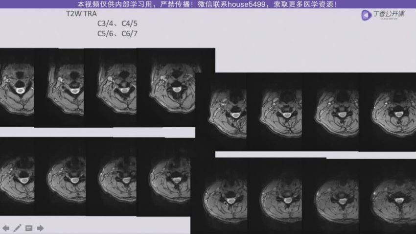 丁香园：脊柱MRI进阶指南【共11节】【全】【248元】 百度网盘(8.65G)