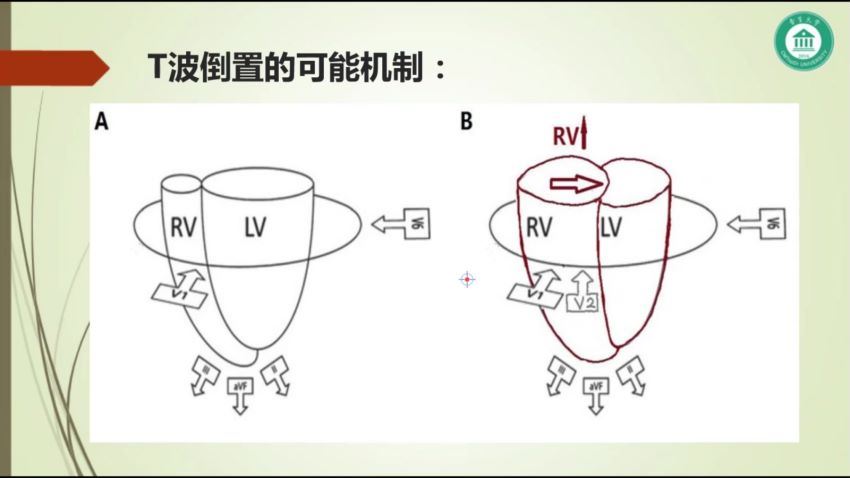 丁香园：肺栓塞心电图诊断 百度网盘(351.56M)