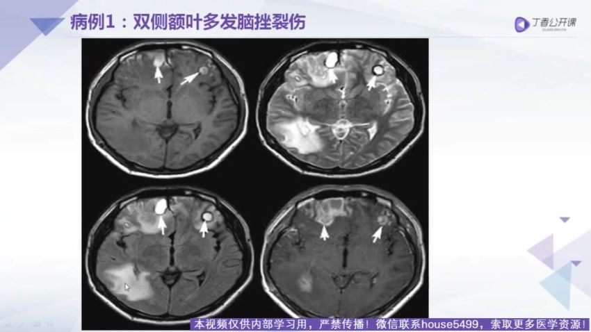 丁香园：手把手教你系统解读颅脑 MRI【共10节】【全】【268元】 百度网盘(7.19G)